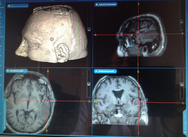 Новый метод лечения опухоли мозга питерского нейрохирурга спас жителя Приморья